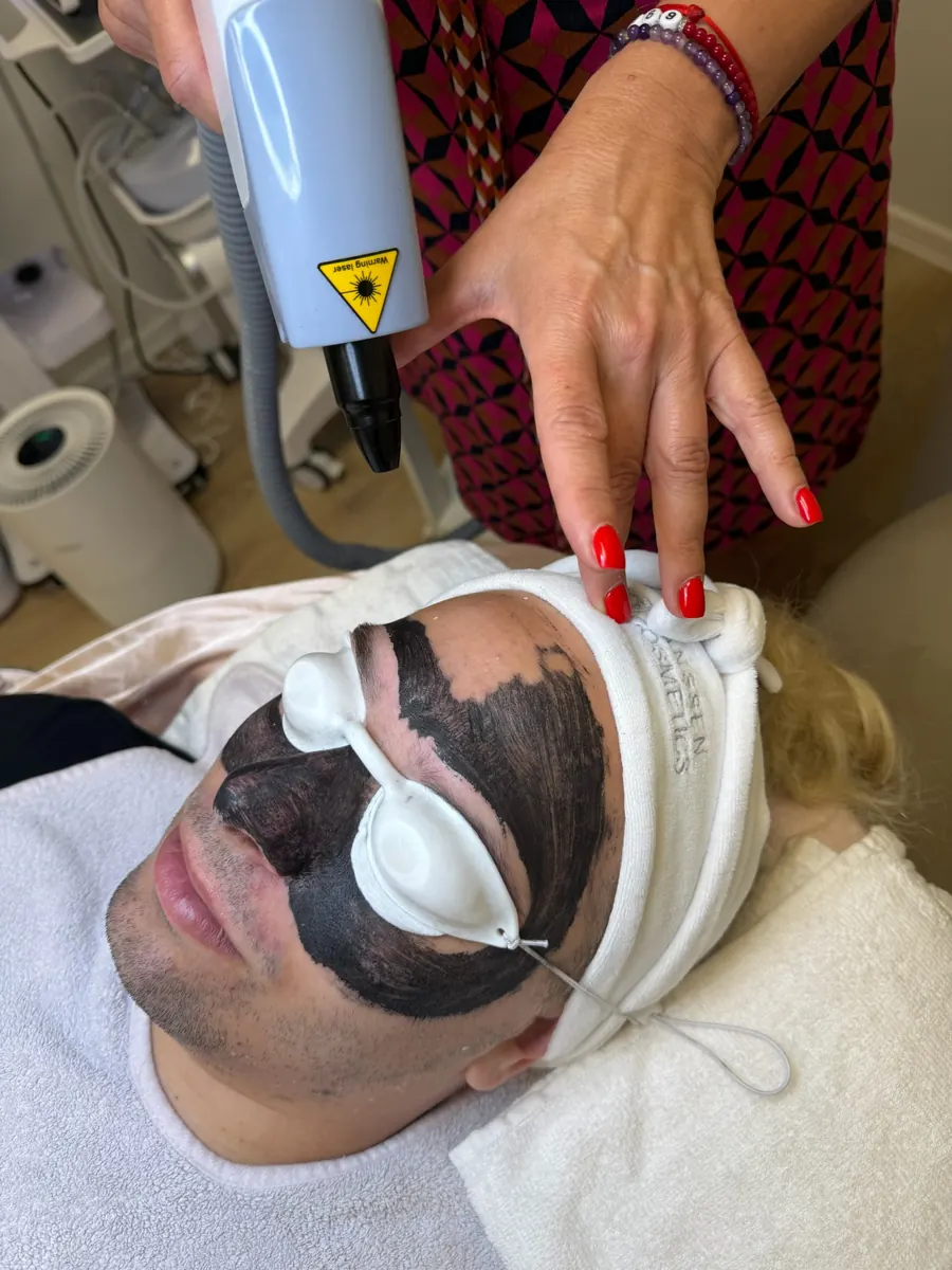 Carbon peeling arckezelés védőszemüveggel és lézerfejjel a Beautyflow for Men szalonban