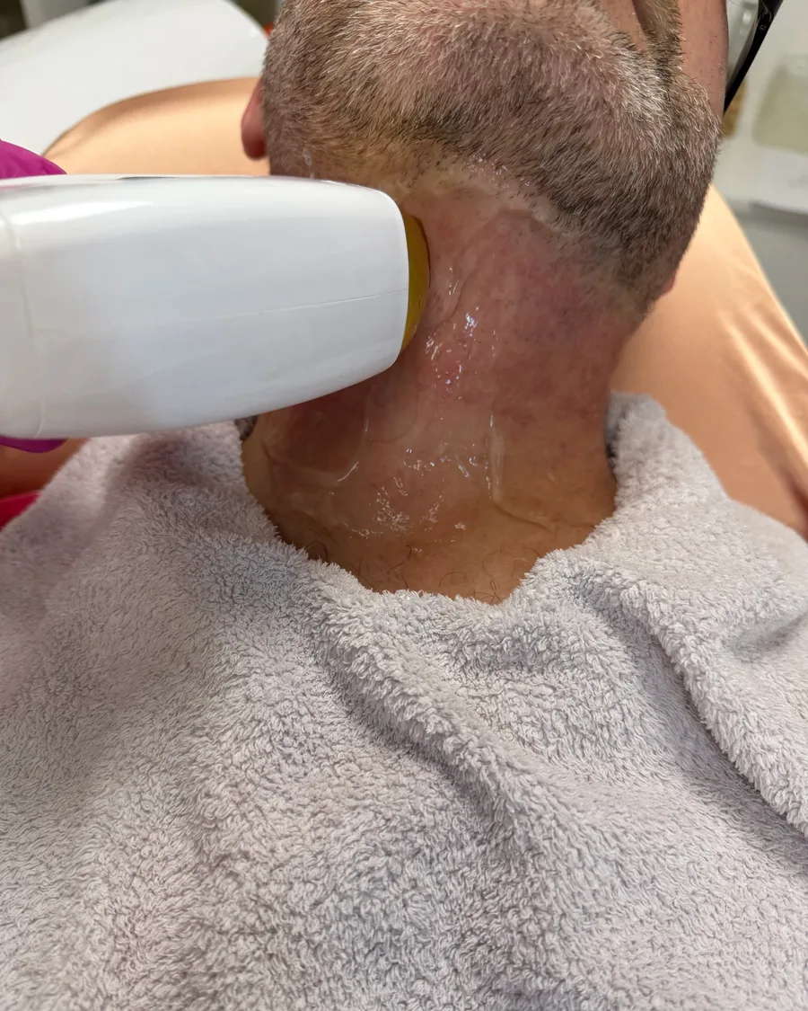 Lézeres szőrtelenítés kezelés a tarkón és a nyakon dióda lézerrel, Beautyflow for Men